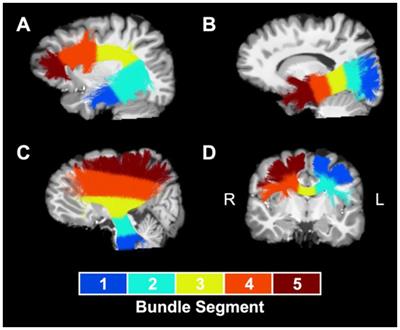 A comparison of altered white matter microstructure in youth born with congenital heart disease or born preterm